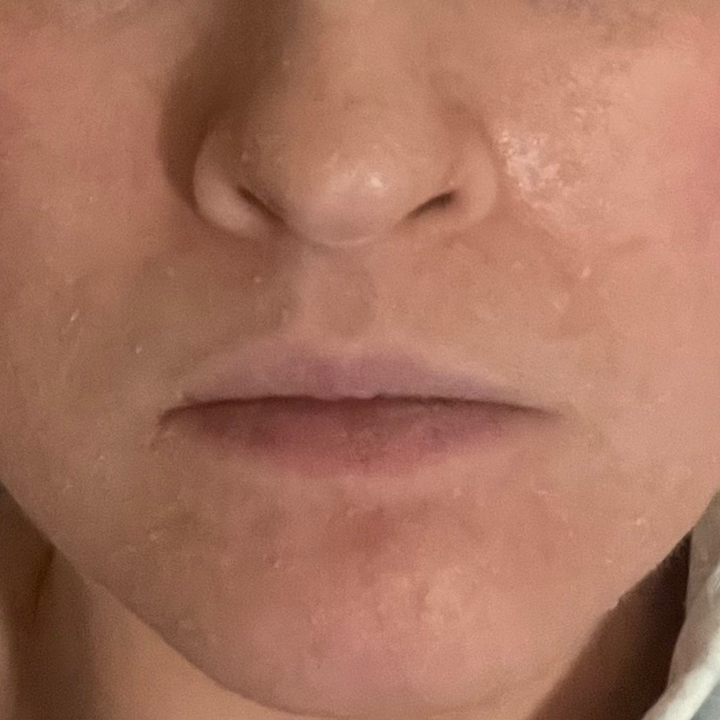 Hypochlorous Acid for Skin After