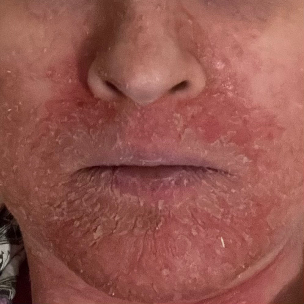 Hypochlorous Acid for Skin Before